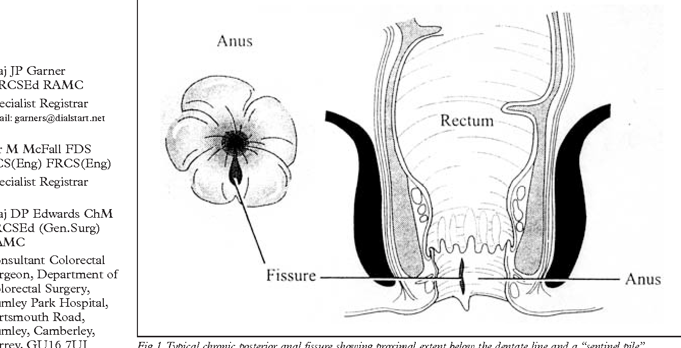 Recurring Anal Fissure Top Porn Images